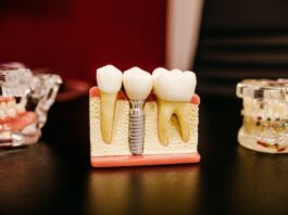 Everything You Need to Know About Mini Dental Implants